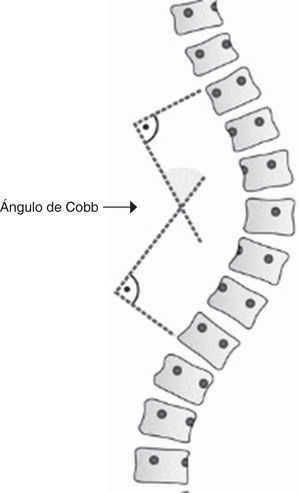 El ángulo de Cobb es un método de medición de la curvatura de la columna en grados.