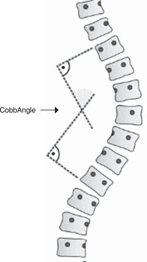 The Cobb angle is a method for measuring the curvature of the spine in degrees.