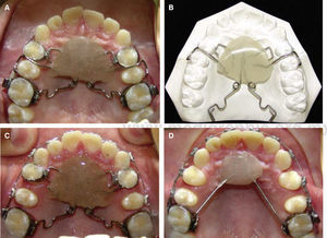 A-D. Molar distalization with a pendulum modified by Dr. Mario Katagiri, Lizie Díaz and Ismael Villa which consists in bands in the first bicuspids with a welded bracket palatally in which a 0.017” × 0.025” stainless steel wire is introduced, circumferential retainers in the second bisupids and TMA springs in the lingual boxes of the upper first molar.