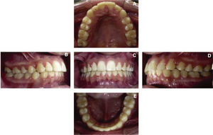 A-E. Left and right molar class I, bilateral canine class I, aligned dental midlines.