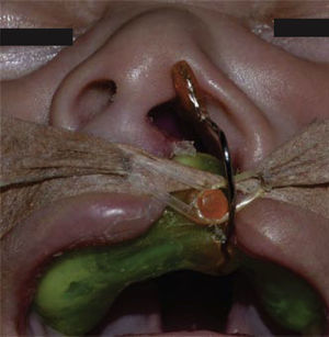 Foto intermedia frontal conformador nasal.