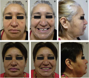 Fotografías comparativas faciales iniciales (A, B, C) y finales (D, E, F).