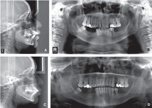 Initial (A, B) and final radiographs (C, D).