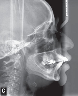 Initial lateral headfilm.