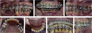 Intraoral treatment sequence photographs.
