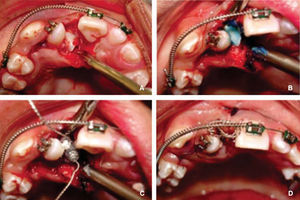 Cirugía periodontal. A) Se levanta colgajo. B) Se acondiciona diente con grabado ácido. C) Colocación y polimerizado de botón para tracción. D) Se reposiciona el colgajo.