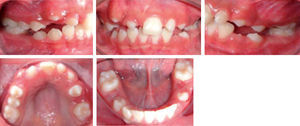 Initial intraoral clinical photographs.