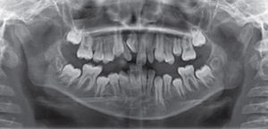 Ortopantomography that shows the retention of the upper right central incisor and microdontia of the upper lateral incisors.