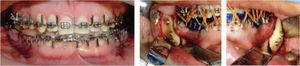Osteotomía bilateral sagital de rama mandibular, férula final.