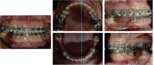 Ortodoncia postquirúrgica, asentamiento de la oclusión y ajuste oclusal.