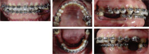 Ortodoncia prequirúrgica.