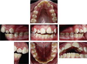 Análisis intraoral. Se observa la mordida abierta anterior, línea media inferior desviada, relación molar clase II molar bilateral, canina clase II bilateral, arcada triangular superior y ovoide inferior.
