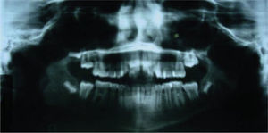 Radiografía panorámica. Se observa paralelismo radicular y la presencia de los gérmenes dentarios 18, 28, 38 y 48.