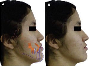 A) Simulación digital de movimientos de la mandíbula, B) fotografía.
