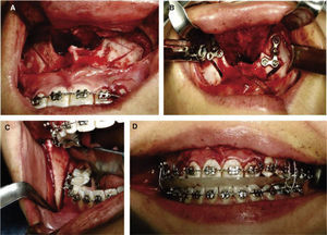 A) Osteotomía segmentaria maxilar, B) fijación rígida con placas de titanio, C) osteotomía sagital con retroceso mandibular, D) férula oclusal intermedia.