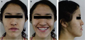 Extraorales prequirúrgica: A) frente, B) sonrisa, C) perfil.