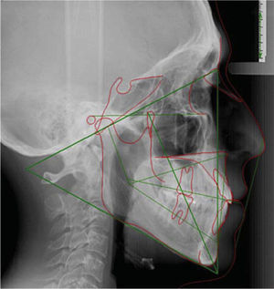 Radiografía lateral de cráneo inicial.