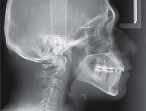 Radiografía lateral de cráneo final.