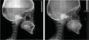 Radiografías laterales de cráneo; inicial y final.