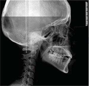 Radiografía lateral del cráneo inicial.