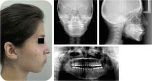 Fotografía extraoral de perfil, radiografía lateral de cráneo, posteroanterior y ortopantomografía prequirúrgica.