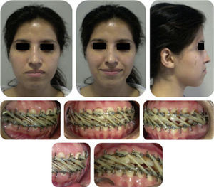 Estado extraoral de la paciente siete días después de la cirugía ortognática. Nótese la desviación de las líneas medias dentales.