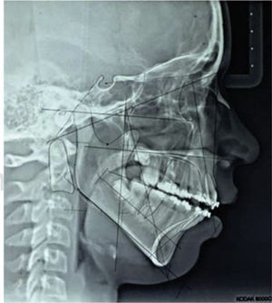 Final lateral headfilm with McLaughlin cephalometric tracing.