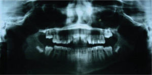 Panoramic radiograph. Root parallelism is observed as well as the four third molar tooth germs.