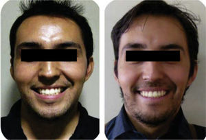 Initial and final smile photographs.