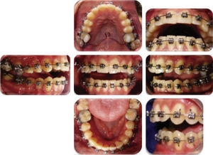 Placement of occlusal bite turbos.