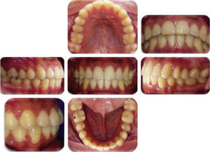 Final intraoral photographs.