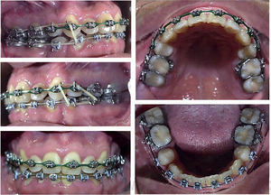 Occlusal intercuspation.