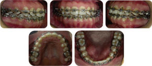 Intraoral status 23 months in treatment.