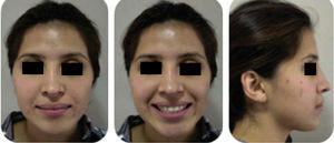 Final extraoral photographs; frontal, smile and profile.