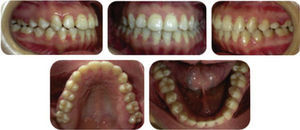 Final intraoral photgraphs; frontal, smile and profile.