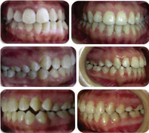 Initial and final intra oral photographs.