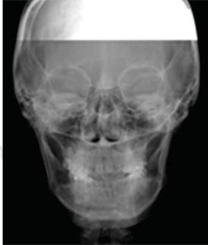 Initial posterior-anterior radiograph.