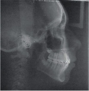 Final lateral headfilm.