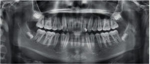 Final panoramic radiograph.