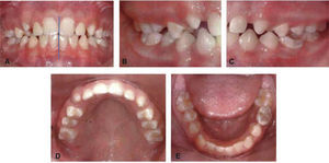 Initial intraoral photographs. A) Front, B) Right side, C) Left side, D) Upper occlusal, E) Lower occlusal.