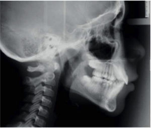 Initial lateral headfilm.