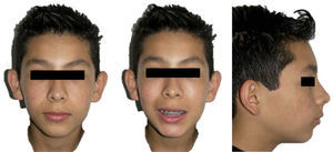 Treatment progress extraoral photographs.
