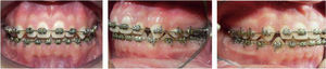 Treatment progress intraoral photographs.