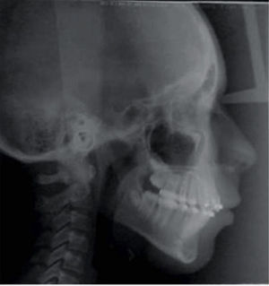Treatment progress lateral headfilm.