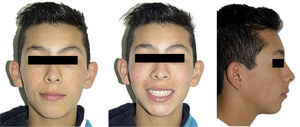 Final extraoral photographs.
