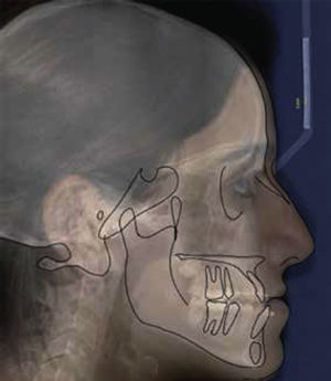 Relación 1:1 de imagen clínica, cefalograma lateral y formato de estructuras óseas y contorno facial.