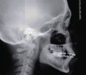 Fotografía de la radiografía lateral. Se observa buena relación maxilo-mandibular.