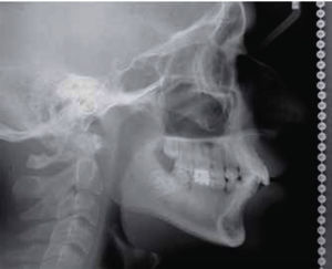 Radiografía lateral inicial de cráneo.