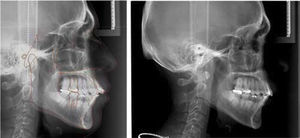 Comparativo de radiografía lateral de cráneo inicial y final.