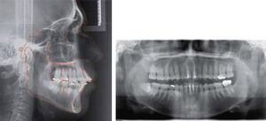 Radiografía lateral de cráneo y ortopantomografía iniciales.